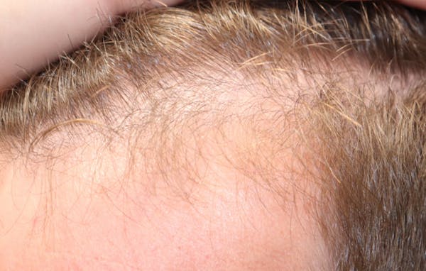 Hair Restoration with Exosomes Gallery - Patient 21033294 - Image 4