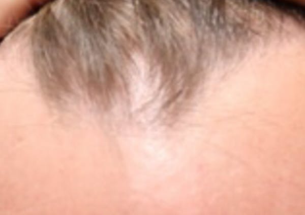 Hair Restoration with Exosomes Before & After Gallery - Patient 21033294 - Image 5