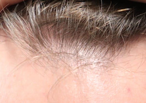 Hair Restoration with Exosomes Before & After Gallery - Patient 21033294 - Image 6