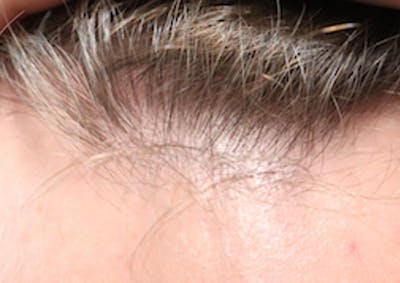 Hair Restoration with Exosomes Gallery - Patient 21033294 - Image 6