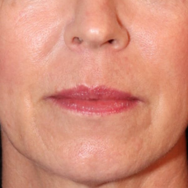 Exosome Facial