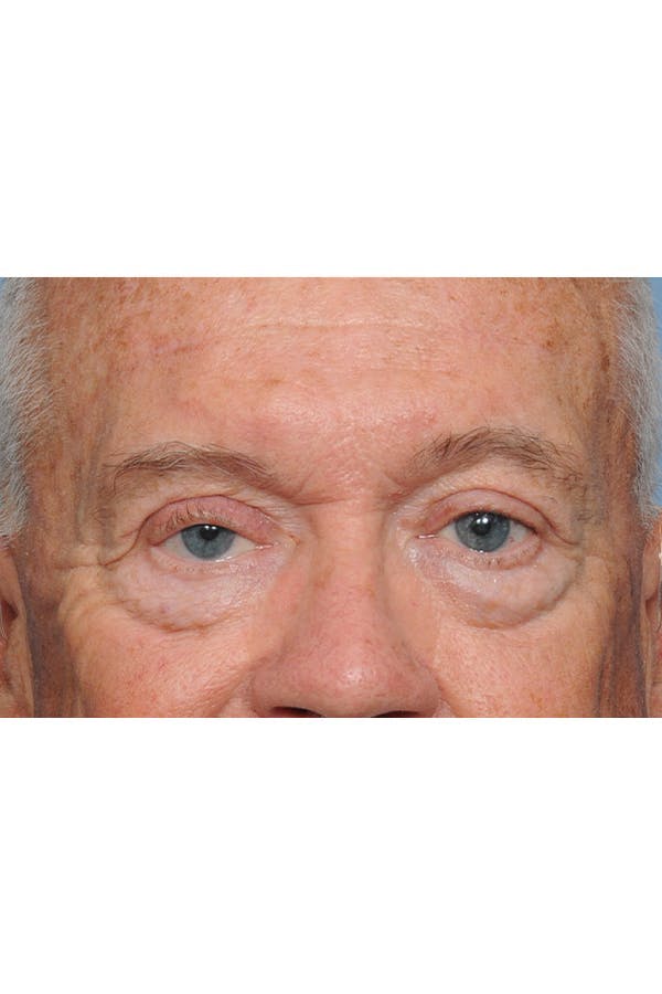 Eyelid Lift Before & After Gallery - Patient 8376646 - Image 4