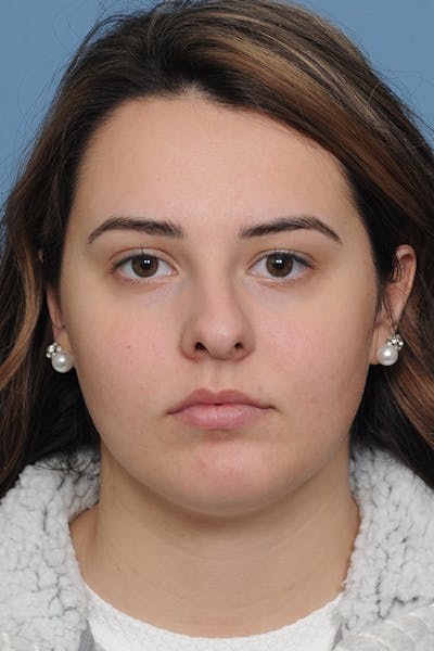 Rhinoplasty Before & After Gallery - Patient 8376727 - Image 1