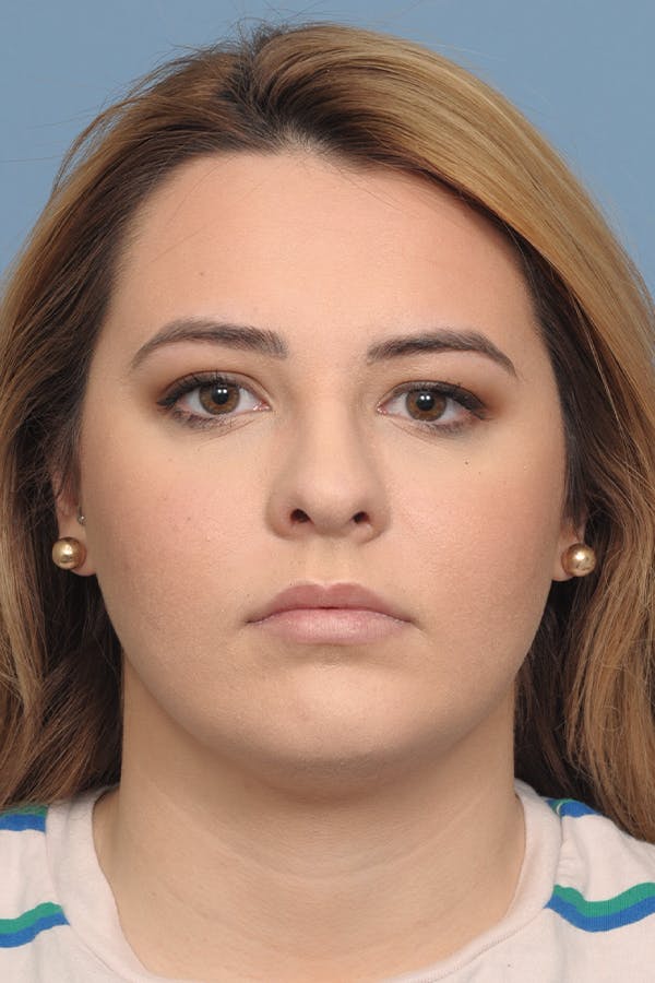 Rhinoplasty Before & After Gallery - Patient 8376727 - Image 2