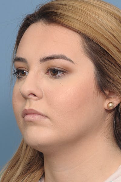 Rhinoplasty Before & After Gallery - Patient 8376727 - Image 4