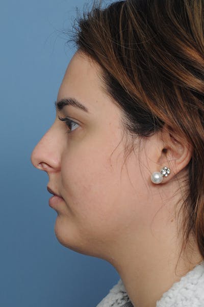 Rhinoplasty Before & After Gallery - Patient 8376727 - Image 1