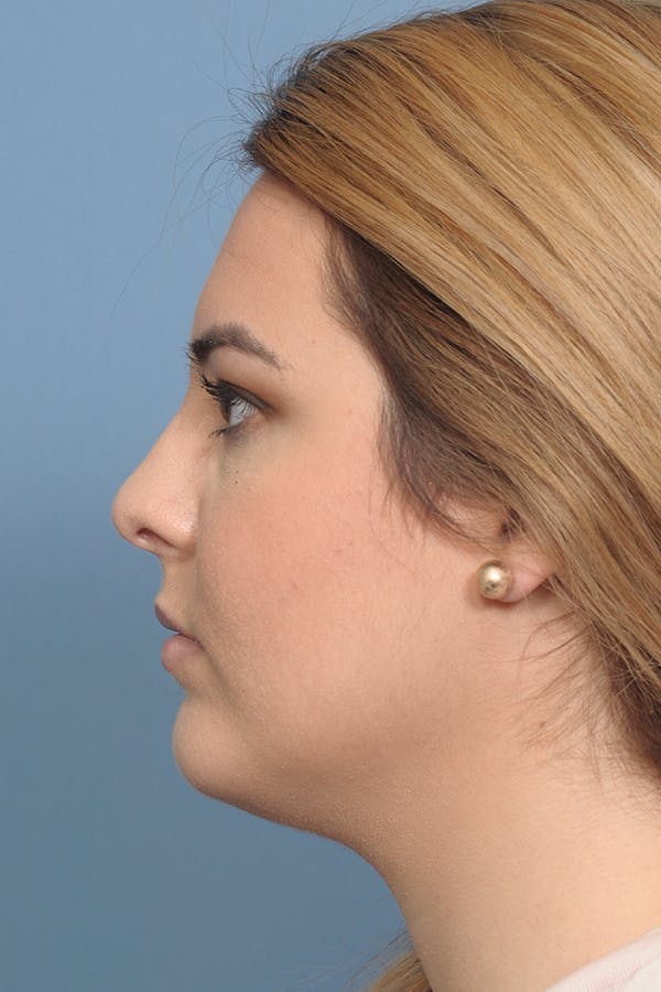 Rhinoplasty Before & After Gallery - Patient 8376727 - Image 6