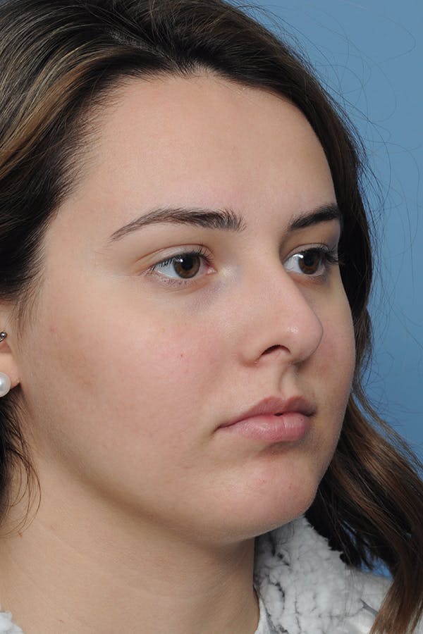 Rhinoplasty Before & After Gallery - Patient 8376727 - Image 7