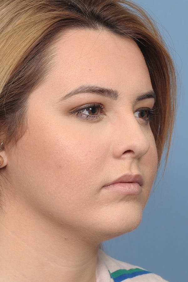Rhinoplasty Before & After Gallery - Patient 8376727 - Image 8