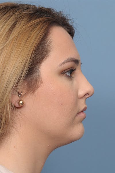 Rhinoplasty Before & After Gallery - Patient 8376727 - Image 10