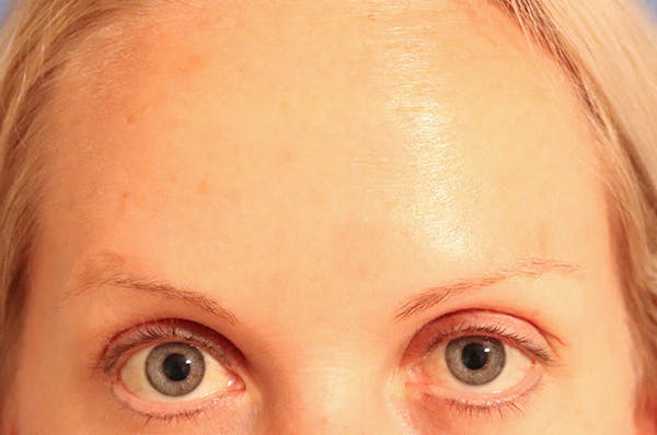 Neuromodulators Before & After Gallery - Patient 121257941 - Image 2