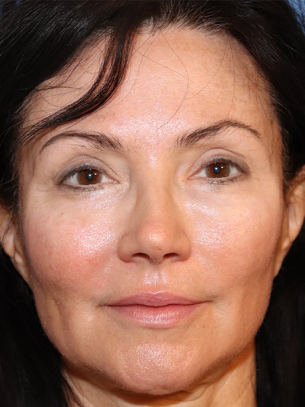Filler Refinement Before & After Gallery - Patient 32750026 - Image 3
