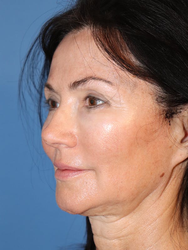 Cheek & Under Eye Filler Before & After Gallery - Patient 145843863 - Image 1