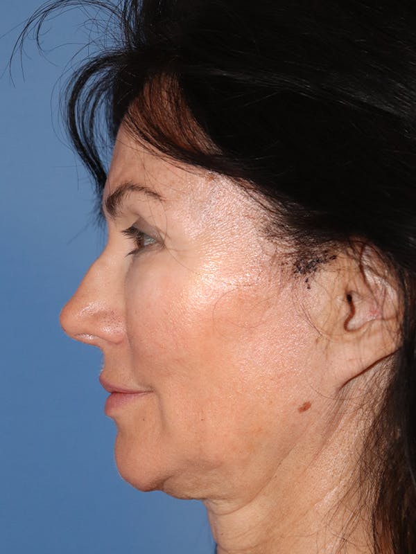 Cheek & Under Eye Filler Before & After Gallery - Patient 145843863 - Image 5