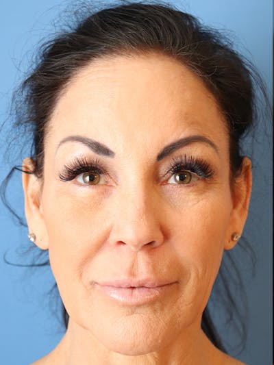 Filler Refinement Before & After Gallery - Patient 32750028 - Image 2