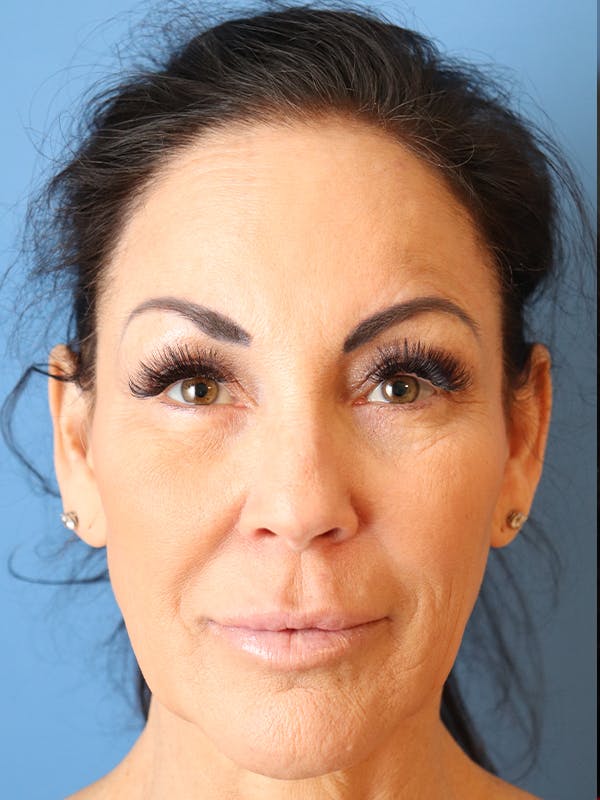Cheek & Under Eye Filler Before & After Gallery - Patient 144976763 - Image 2