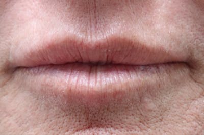 Lip Filler Before & After Gallery - Patient 144976766 - Image 1