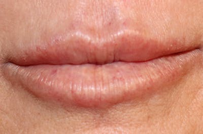 Lip Filler Before & After Gallery - Patient 144976766 - Image 2