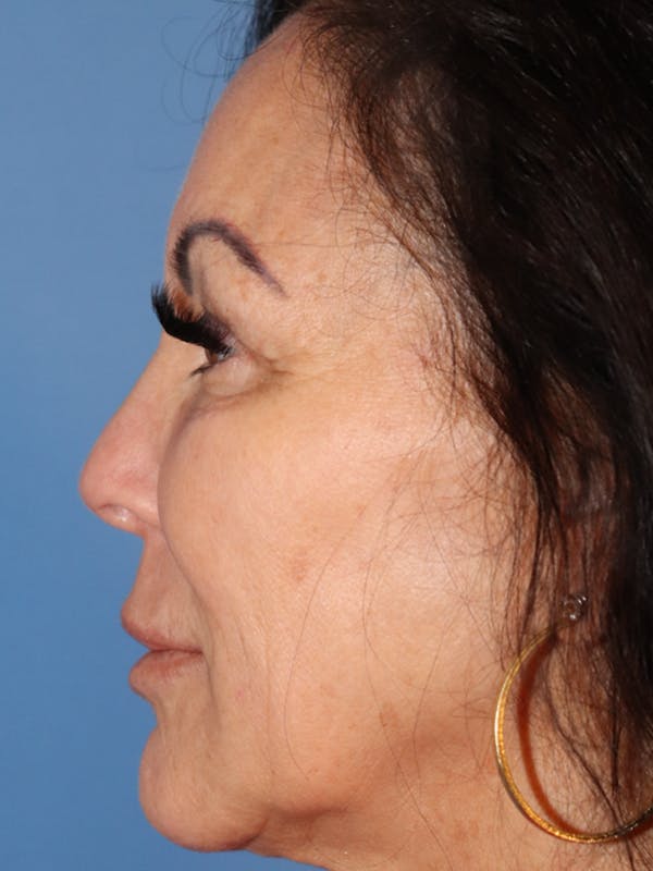 Cheek & Under Eye Filler Before & After Gallery - Patient 144976763 - Image 5