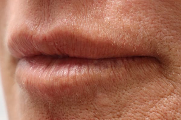 Lip Filler Before & After Gallery - Patient 144976766 - Image 3