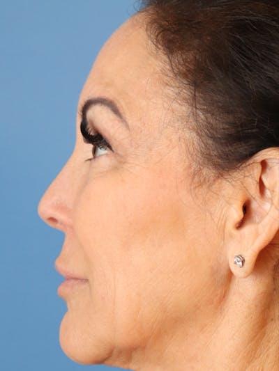 Cheek & Under Eye Filler Before & After Gallery - Patient 144976763 - Image 6
