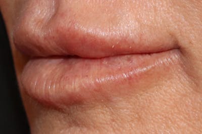 Lip Filler Before & After Gallery - Patient 144976766 - Image 4