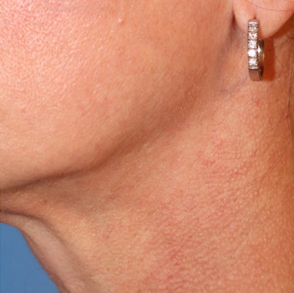 Microneedling Before & After Gallery - Patient 77039298 - Image 1