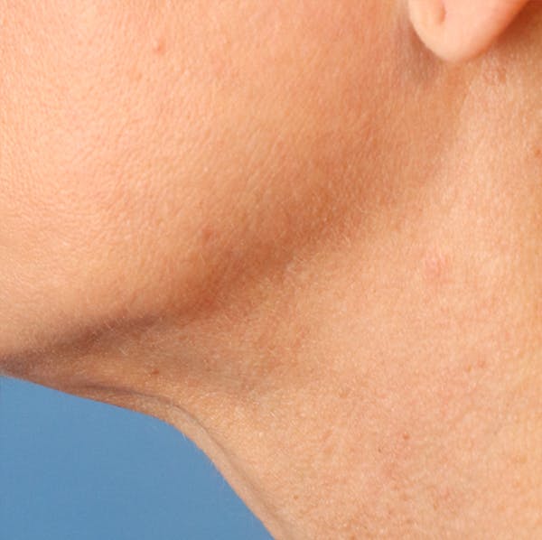 Microneedling Before & After Gallery - Patient 77039298 - Image 2