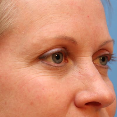 Microneedling Before & After Gallery - Patient 77039596 - Image 1