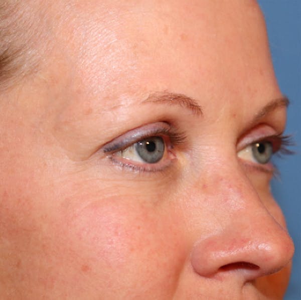 Microneedling Before & After Gallery - Patient 77039596 - Image 2