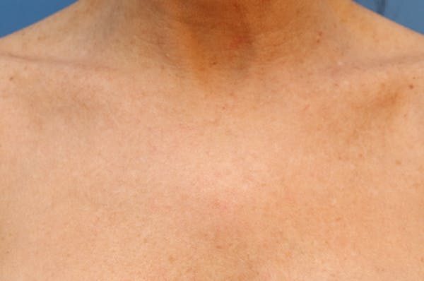 Microneedling Before & After Gallery - Patient 77040321 - Image 5