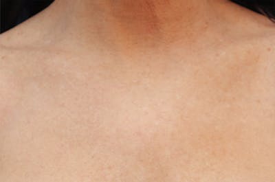 Microneedling Before & After Gallery - Patient 77040321 - Image 6