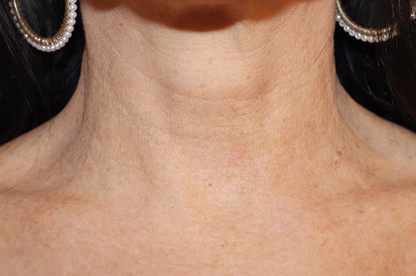 Microneedling Before & After Gallery - Patient 77040321 - Image 4