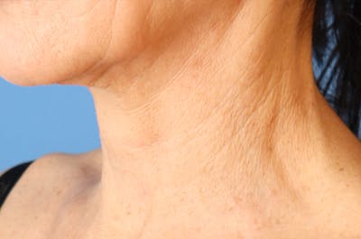 Microneedling Before & After Gallery - Patient 77040321 - Image 1