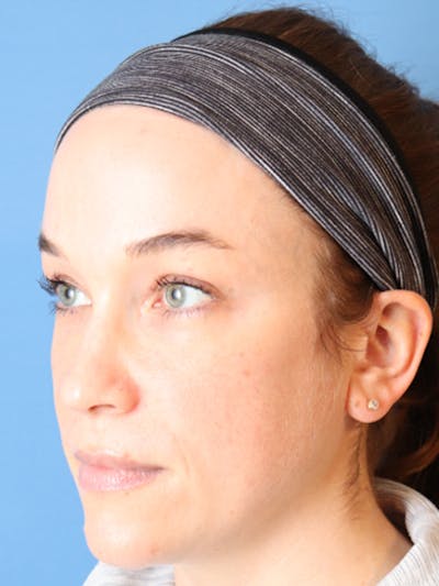 PRP Facial Before & After Gallery - Patient 32763358 - Image 1