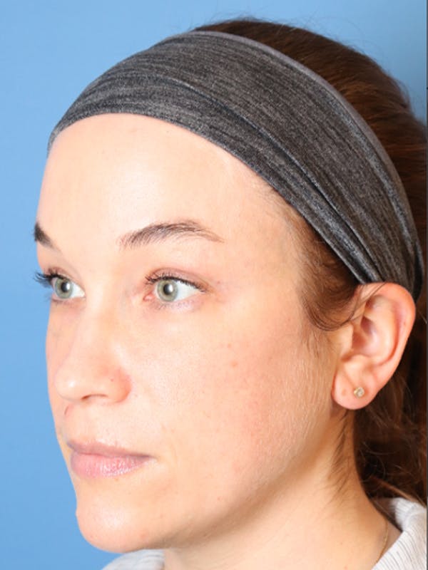 PRP Facial Before & After Gallery - Patient 32763358 - Image 2
