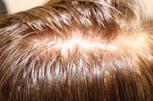 Before and after Hair Restoration with Exosomes in Austin