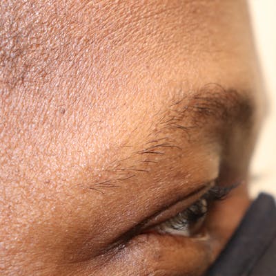 Hair Restoration with Exosomes Before & After Gallery - Patient 32769538 - Image 4