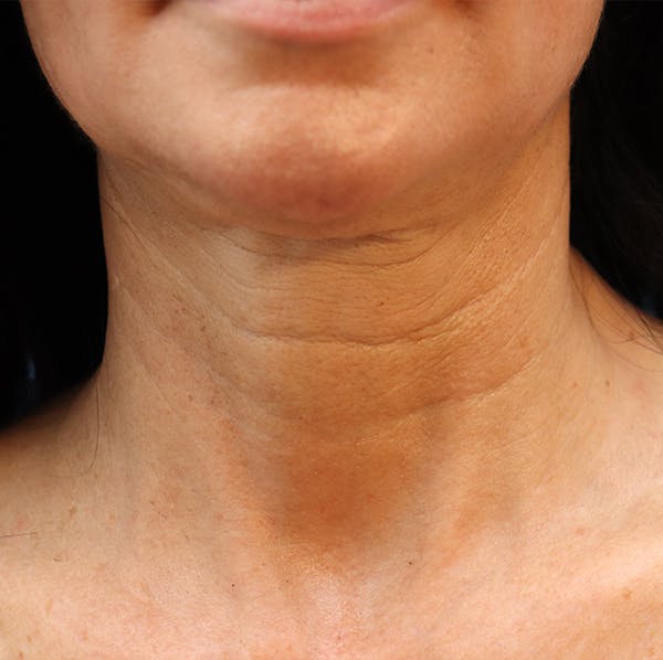 Jawline & Neck Filler Before & After Gallery - Patient 144976756 - Image 1