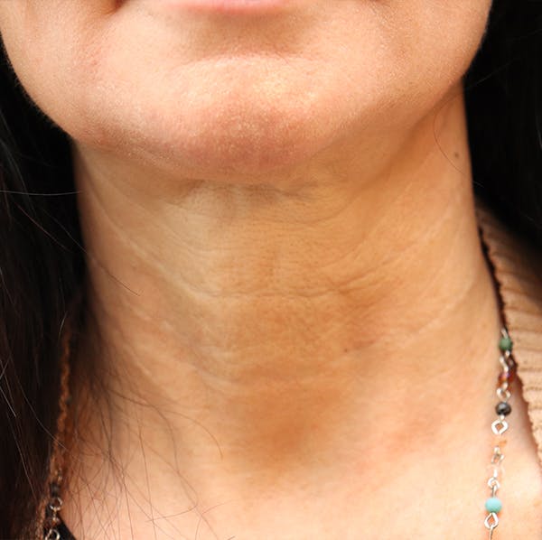 Jawline & Neck Filler Before & After Gallery - Patient 144976756 - Image 2