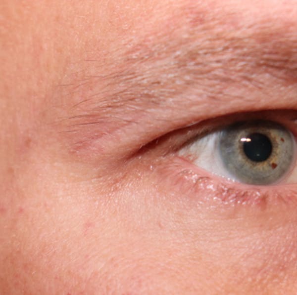 Microneedling Before & After Gallery - Patient 77040324 - Image 4