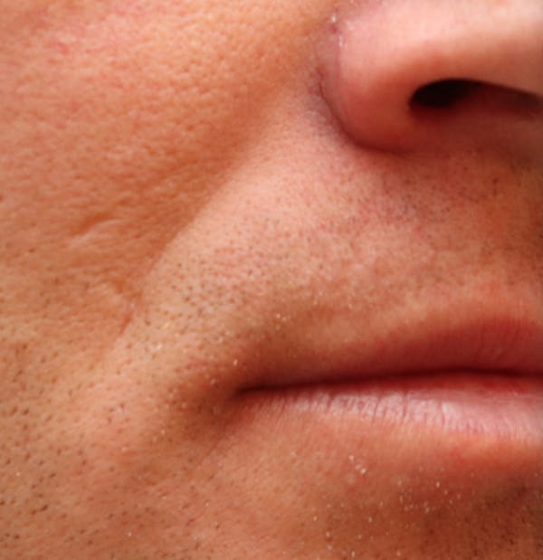 Microneedling Before & After Gallery - Patient 77040366 - Image 3
