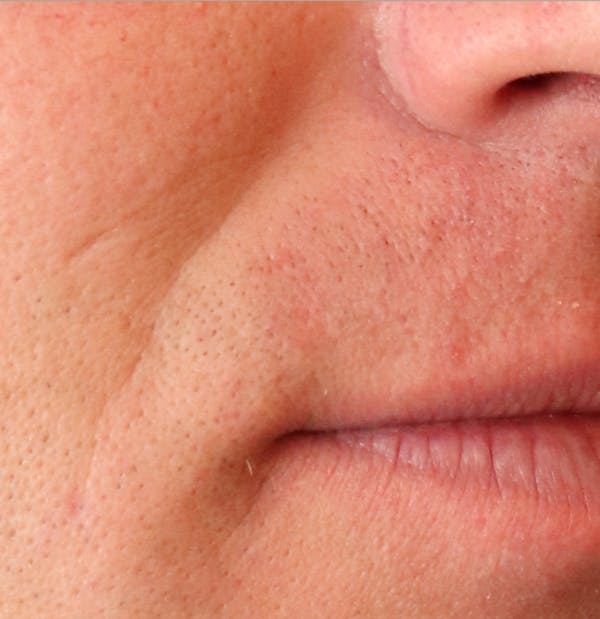 Microneedling Before & After Gallery - Patient 77040366 - Image 4