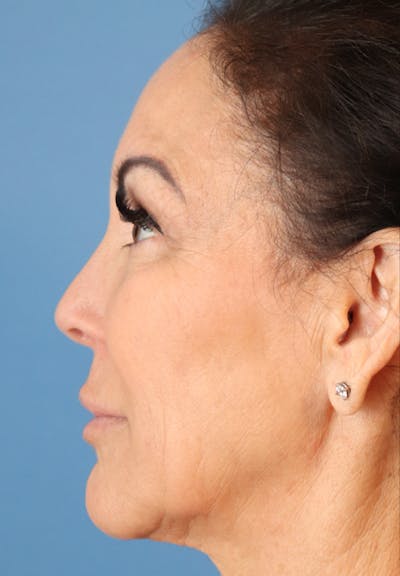 Microneedling Before & After Gallery - Patient 77039598 - Image 6