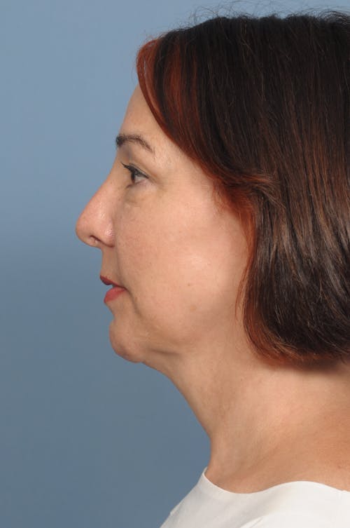 Chin Implant