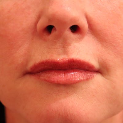 Filler Refinement Before & After Gallery - Patient 46967264 - Image 1
