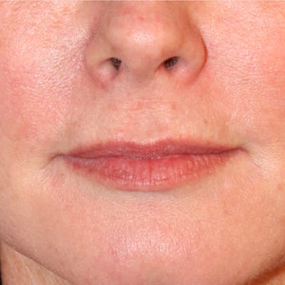 Filler Refinement Before & After Gallery - Patient 46967264 - Image 2