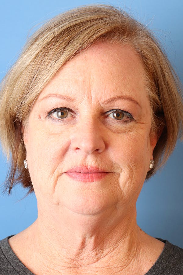 Facelift Before & After Gallery - Patient 29785271 - Image 1