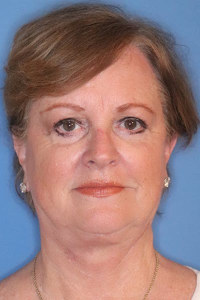 Facelift Before & After Gallery - Patient 29785271 - Image 2