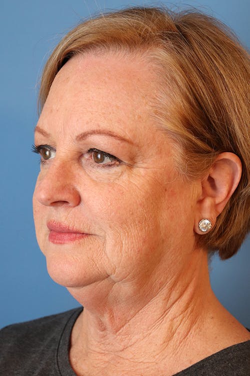Mini Facelift Before & After Photos